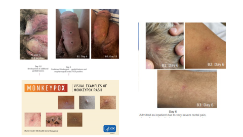 Pictures of Monkeypox lesions on various body parts.